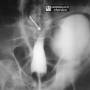 abd-bird_of_prey_sigmoid_volvulus-be.jpg