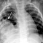 abd-cottage_loaf-diaphragmatic_hernia-r3.jpg