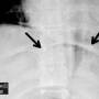 abd-cupola_sign_of_pneumoperitoneum.jpg