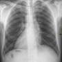 hrt-300px-situs_inversus_chest_nevit.jpg