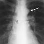 hrt-aortic_nipple_cu_chest.jpg