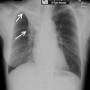 lung-golden_s_sign_ap.jpg